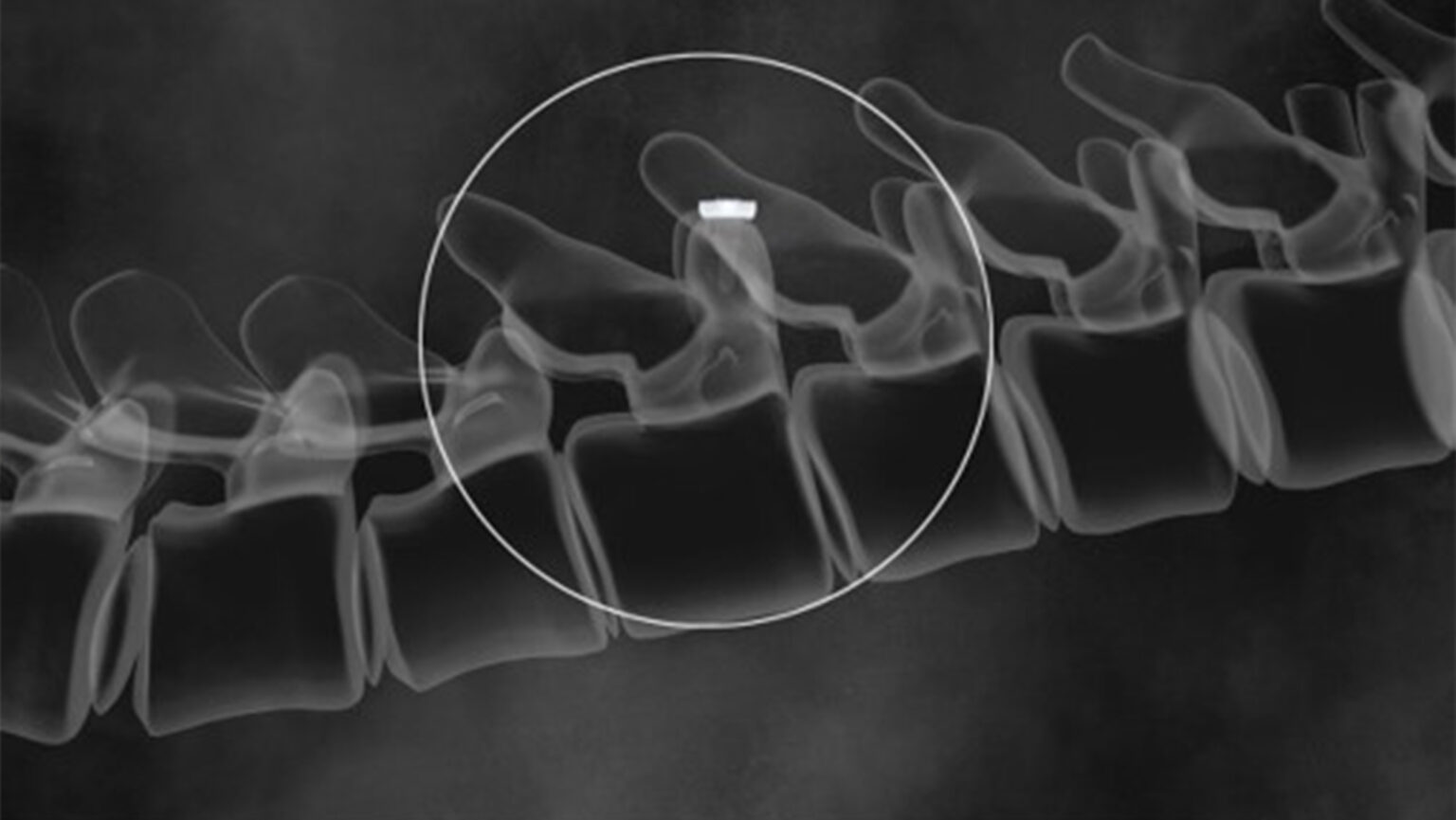 SURGENTEC ALARA Needle