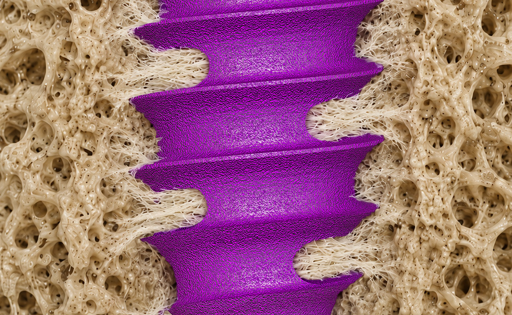 bone-graft-integration-alt